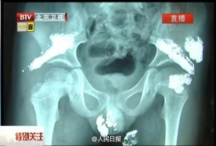 Severe mercury poisoning found in 5-year-old boy