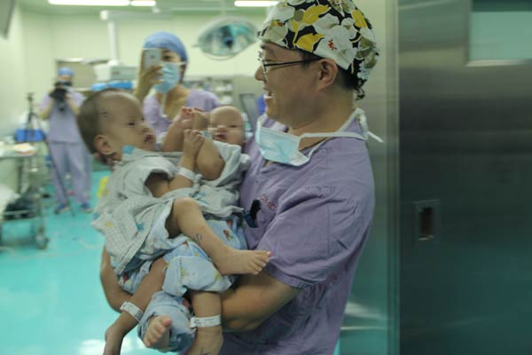 Medical team successfully separates conjoined twins