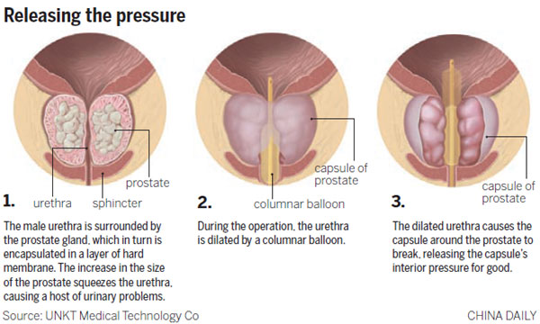 New prostate procedure could bring relief to rural millions