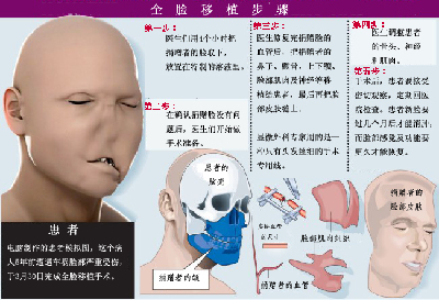 西班牙成功完成世界首例全臉移植術 患者因車禍毀容