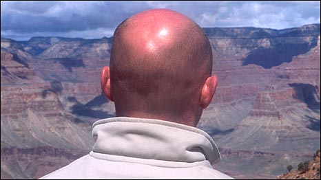 Cause of Baldness 科學家揭曉禿頭的原因