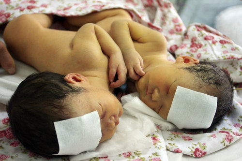 Conjoined twin girls wait for separation