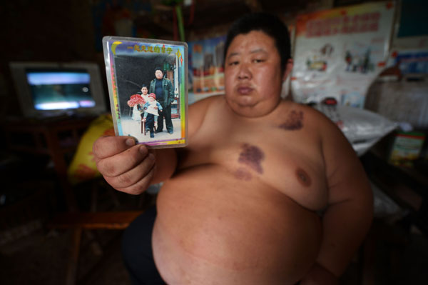 At 180kg, man becomes Chongqing's heaviest