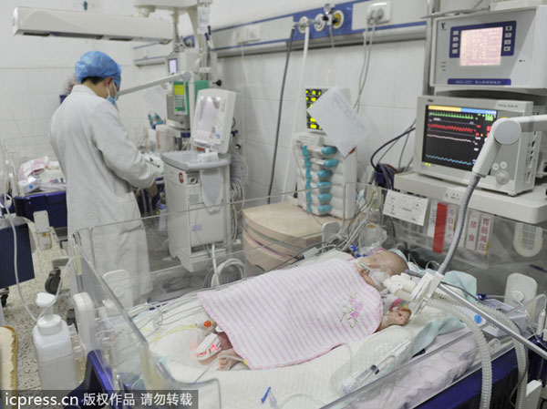 Conjoined babies separated in E China