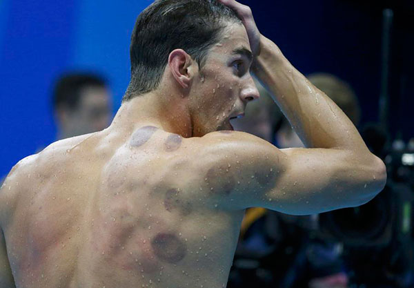 Phelps puts spotlight on cupping